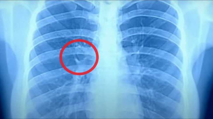Что показывает рентген лёгких при коронавирусе и как выглядят лёгкие при ковиде?