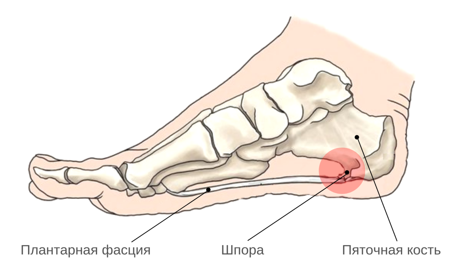 Где находится пяточная шпора. Ахиллова пяточная шпора. Пяточная шпора ахиллова сухожилия. Ахиллова шпора пяточной кости. Плантарный фасциит рентген.