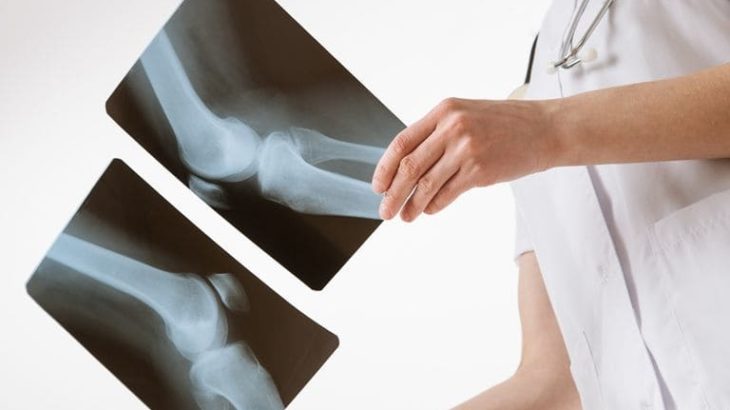 УЗИ коленного сустава или рентген — что лучше?