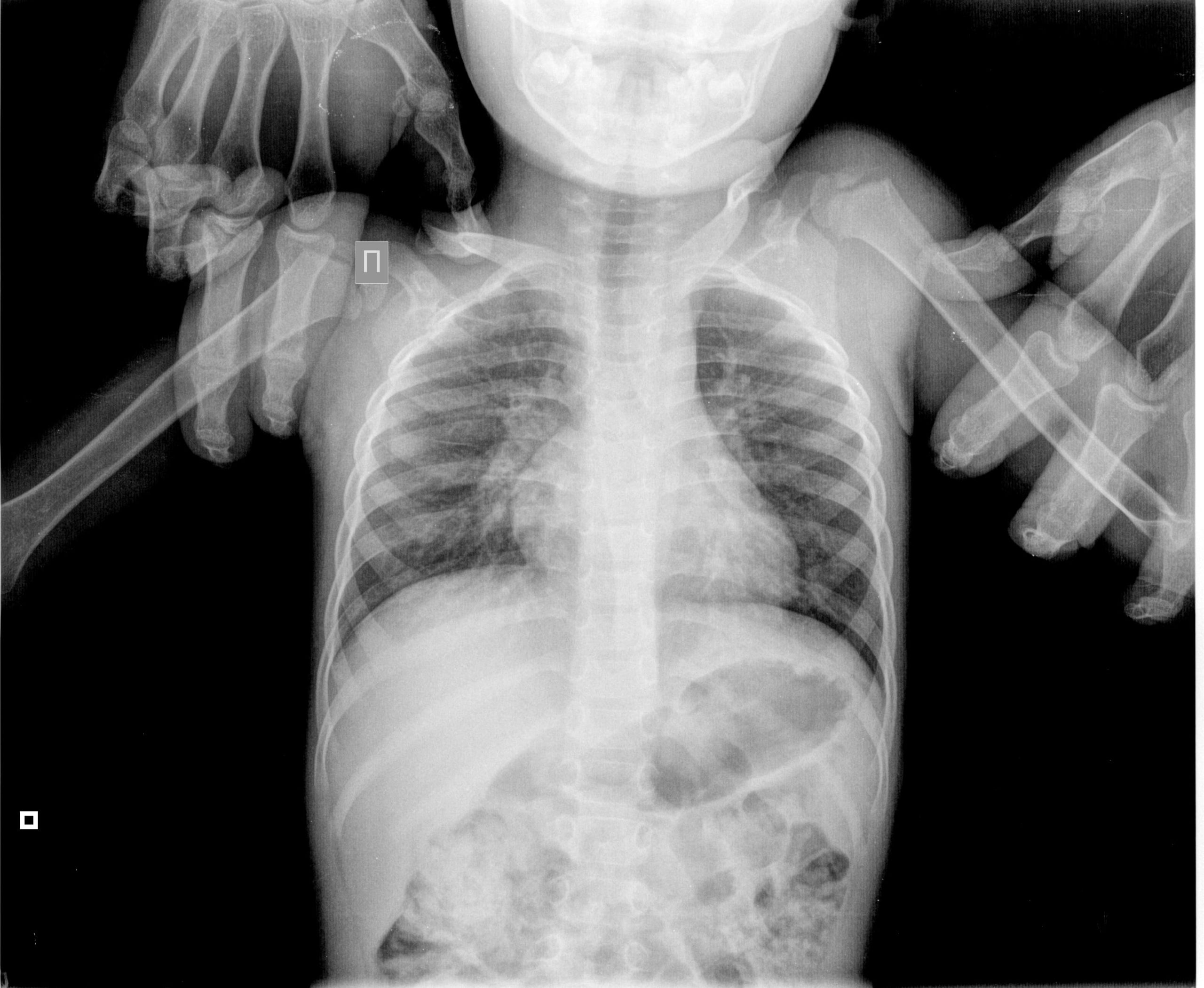 Как на рентгене выглядит пневмония у ребенка