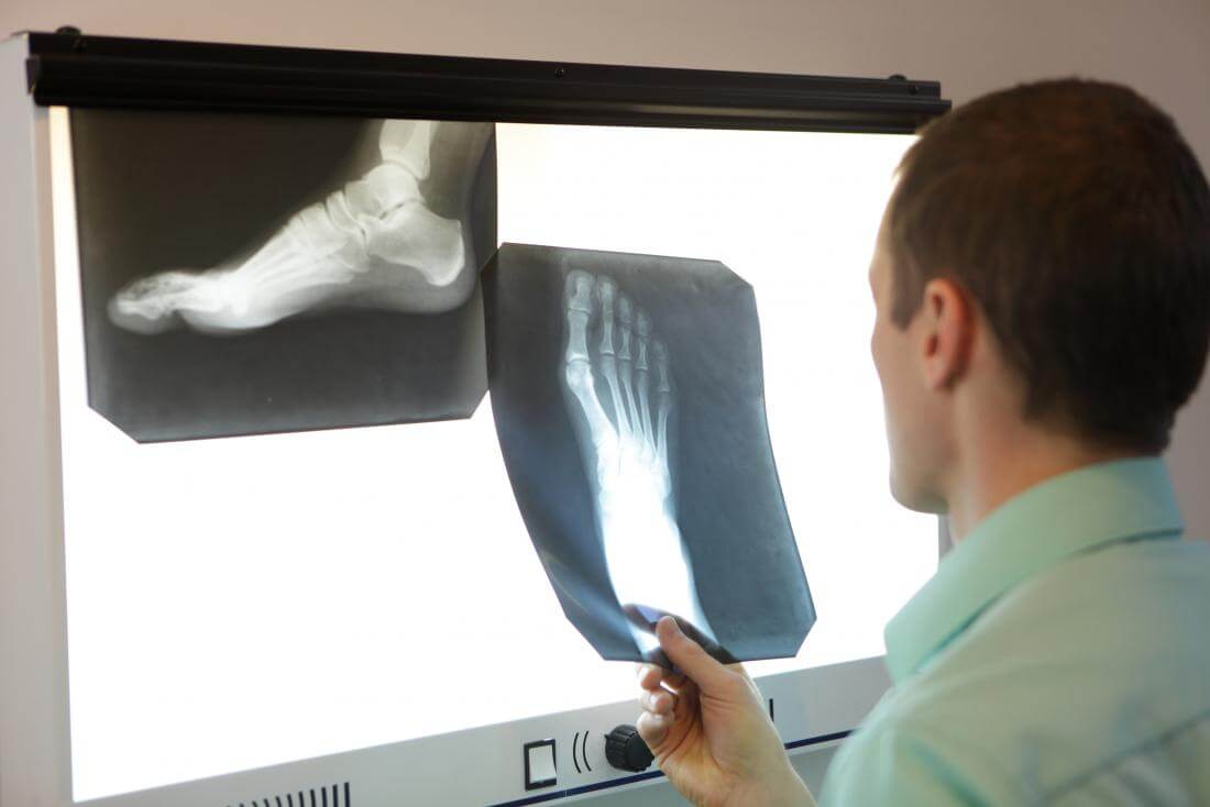 Рентген стопы - как его делают и что он показывает